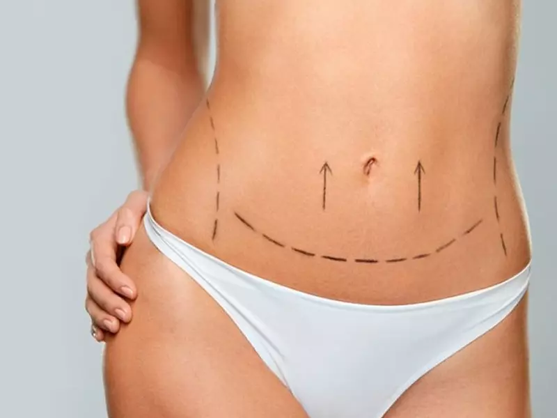 Abdominoplastia