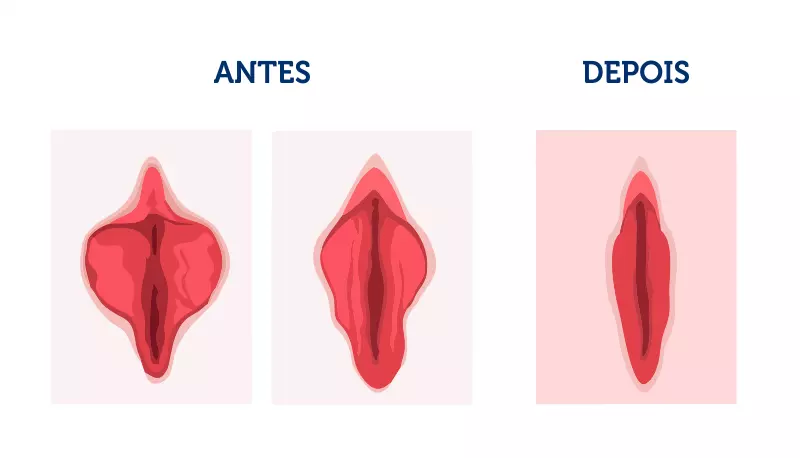 Como é realizada a Ninfoplastia?