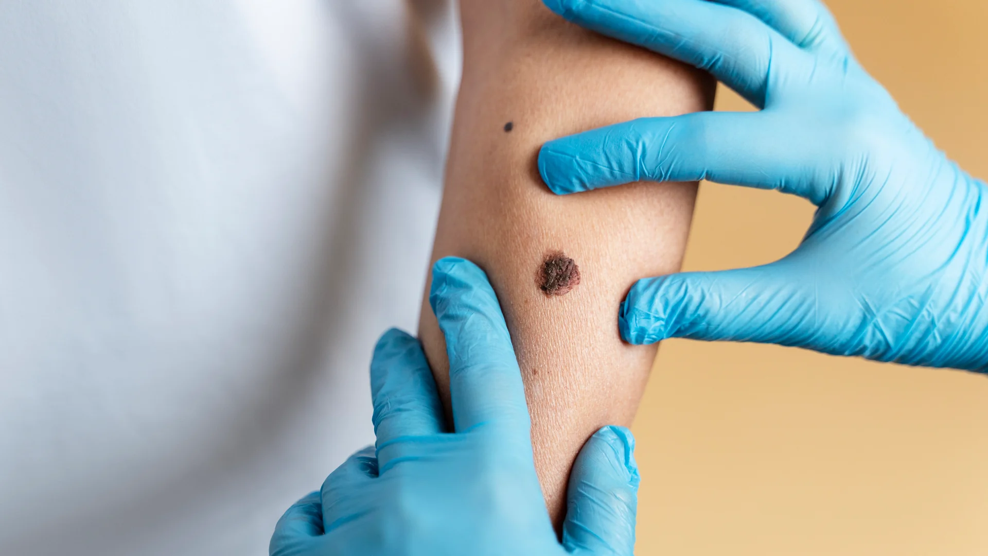 Cirurgia de Câncer de Pele em Poços de Caldas